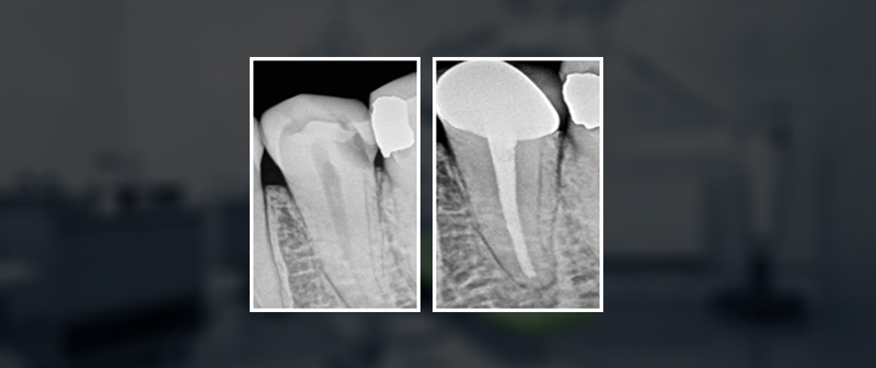 single sitting root canal