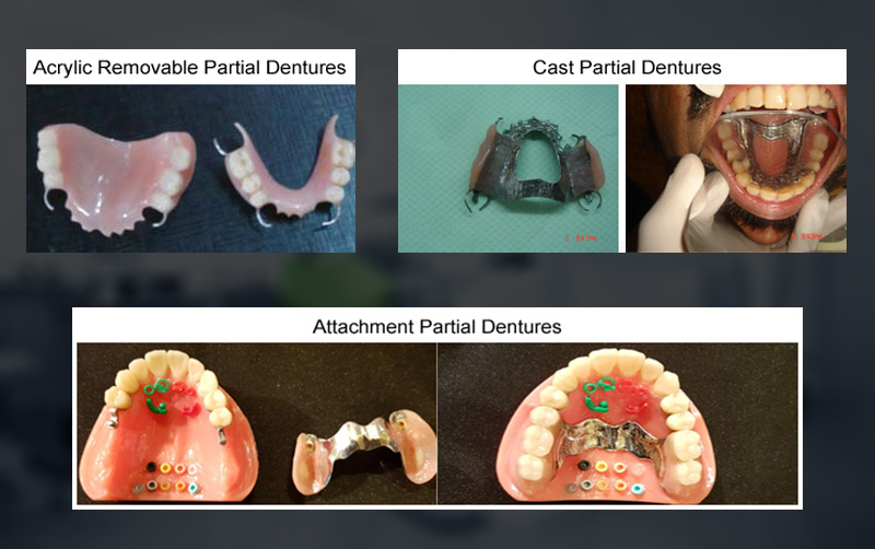 Complete/Partial Dentures