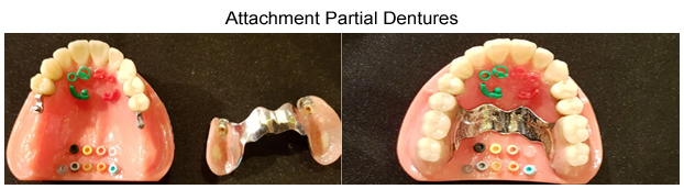 partial dentures